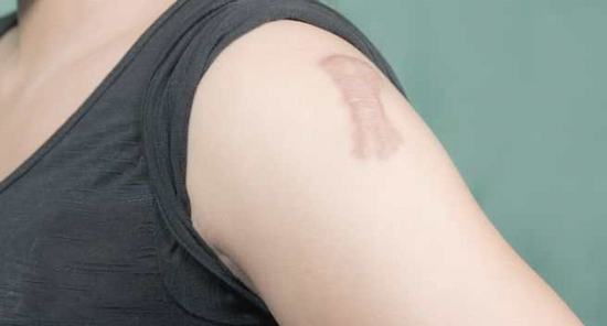 Sẹo lồi thường xuất hiện sau những va chạm hoặc tổn thương lớn trên da.