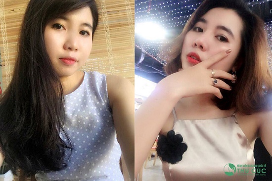 Hình ảnh Thu Mai trước và sau khi nâng mũi S line tại Bệnh viện Thu Cúc, không thể phủ nhận khuôn mặt cô bạn sang trọng hơn trước rất nhiều (Lưu ý: Kết quả có thể khác nhau tùy cơ địa từng người)