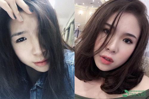Sau cắt mí, Trần Hồng Anh (20 tuổi) cuốn hút hơn trước. (Lưu ý: Kết quả có thể khác nhau tùy cơ địa từng người)