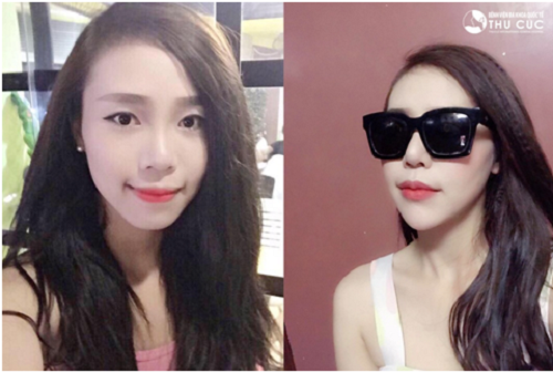 Môi trái tim là biểu tượng của vẻ đẹp gợi cảm, rạng rỡ đầy sức hút… chính vì vậy đây là lý do mà nhiều bạn trẻ lựa chọn dịch vụ thẩm mỹ tạo môi trái tim (Lưu ý: Kết quả có thể khác nhau tùy cơ địa từng người)