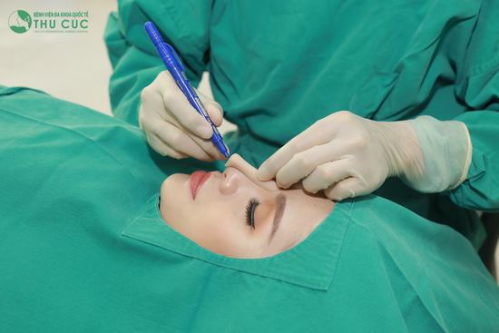 Nâng mũi Liftderm S 5D là sự kết hợp tuyệt vời giữa 3 loại sụn cao cấp nhất trong phẫu thuật nâng mũi đó là sụn sinh học định hình, sụn Megaderm và sụn vô bào nhân tạo Bistool.