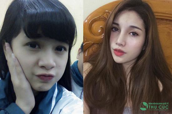 Nhờ kỹ thuật thực hiện chính xác đến từng milimet mà mức độ hài lòng của khách hàng với dịch vụ này lên đến hơn khoảng 95% (Lưu ý: Kết quả có thể khác nhau tùy cơ địa từng người)