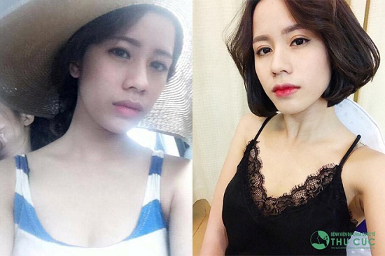 Rất nhiều cô gái đã có được sự thay đổi bất ngờ nhờ can thiệp vào 2 “điểm vàng” trên gương mặt là mắt và môi, trong đó không thể không kể đến cô nàng Hoài Thu (SN 1994, diễn viên múa). (Lưu ý: Kết quả có thể khác nhau tùy cơ địa từng người)