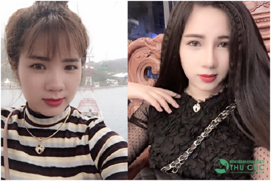 9X Lào Cai thay đổi bất ngờ nhờ chọn đúng dịch vụ thẩm mỹ