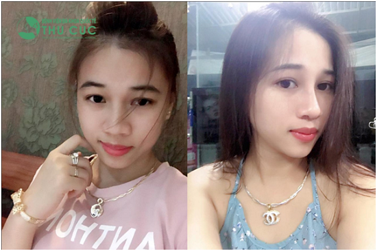 Với thẩm mỹ, con gái chỉ cần cắt mí và nâng mũi là đã rất xinh rồi