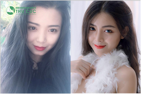 Với thẩm mỹ, con gái chỉ cần cắt mí và nâng mũi là đã rất xinh rồi