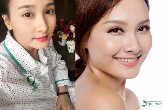 Lý giải cơn sốt phẫu thuật thẩm mỹ cắt mí mắt 2017
