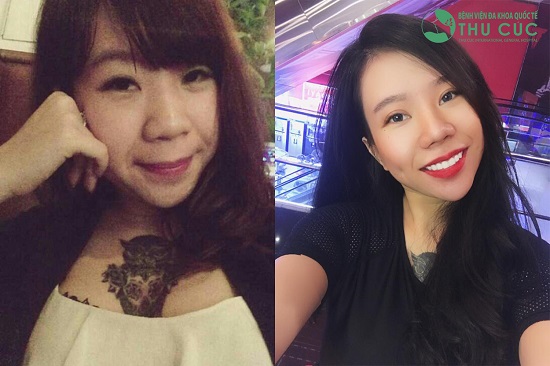 Cô gái Lương Thanh Mai với nếp mí mới cực xinh. Theo các bác sĩ tại Thu Cúc Sài Gòn, bản chất của phương pháp này là sẽ loại bỏ bớt da chùng, mỡ thừa ở mí trên, đồng thời tái tạo đường mí mới sâu, rõ nét và phù hợp gương mặt.
