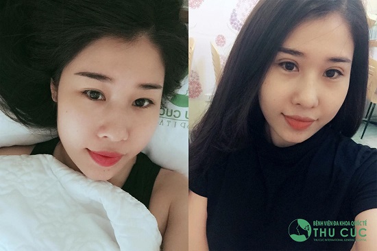 Chỉ với 45 phút phẫu thuật, cô bạn Nguyễn Kim Ngân đã sở hữu đôi mắt 2 mí tươi trẻ. Cũng bởi lý do này mà phương pháp cắt mí trở nên hot hơn bao giờ hết ở thời điểm hiện tại, khi mà Tết dương lịch và Tết Nguyên Đán đang cận kề.