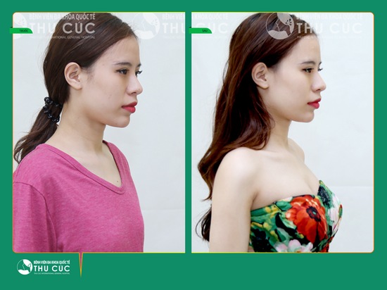 chi phí nâng ngực nội soi giá bao nhiêu tiền