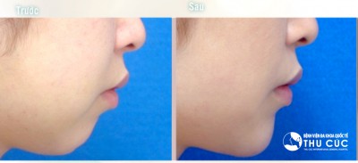 Độn cằm không phẫu thuật 2 Độn cằm không phẫu thuật