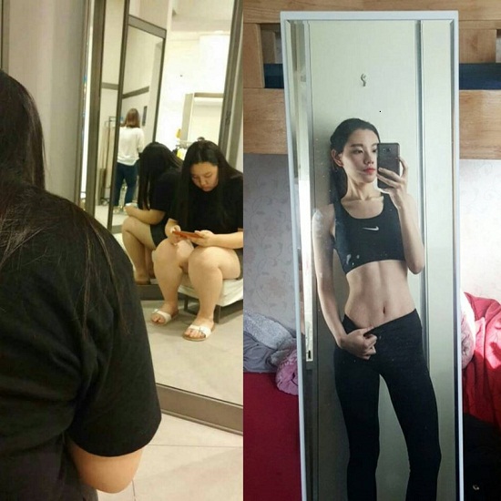 Hiệu quả giảm béo với công nghệ Vaser Lipo tại Thu Cúc (Lưu ý: Kết quả phụ thuộc vào cơ địa từng người)