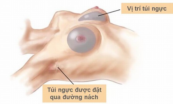 nâng ngực nội soi ở đâu tốt nhất