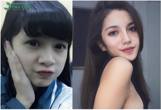 Nâng mũi Lifderm S 5D mang đến gương mặt hoàn hảo đến từng đường nét