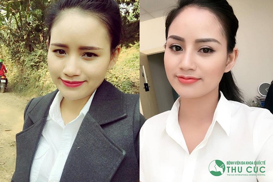 Nhiều bạn trẻ chọn độn cằm, nâng mũi,... bằng phương pháp đơn giản này