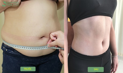 95% khách hàng đã “lột xác” thân hình sau khi sử dụng phương pháp giảm béo bằng Vaser Lipo tại Bệnh viện Thu Cúc (Lưu ý: Kết quả còn tùy thuộc vào cơ địa mỗi người)