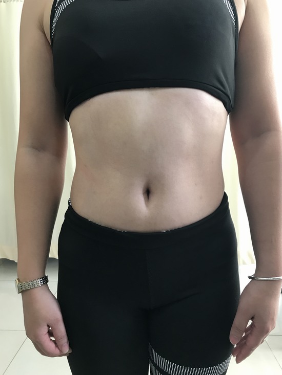 Năng lượng sóng siêu âm “chạm tới mỡ” ở độ sâu 12 cm, phá hủy mỡ thừa và làm tan lỏng mỡ cứng, giúp cô bạn thu gọn 20cm vòng bụng, 5cm vòng tay, 8cm vòng đùi và 7kg cân nặng.