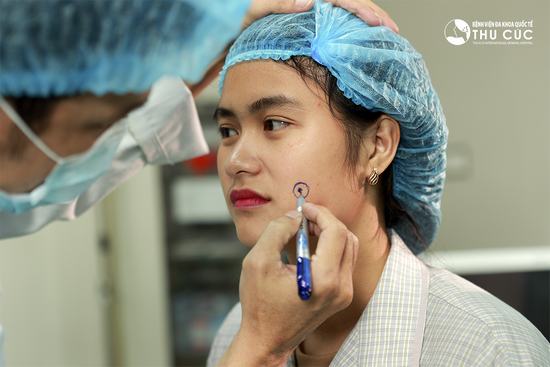 Có nên tạo má lúm đồng tiền không