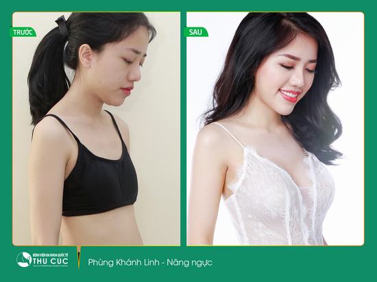 Nữ ca sĩ hạt tiêu Phùng Khánh Linh đã "lột xác thành người lớn" sau khi thực hiện nâng ngực nội soi Nano Chip tại Bệnh viện Thu Cúc