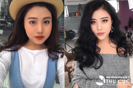 Tiêm filler được xem là biện pháp mang đến hiệu quả “trong một nốt nhạc”. Cô bạn Hương Anh là minh chứng của điều này khi sở hữu khuôn mặt thanh tú chỉ trong 15 phút.
