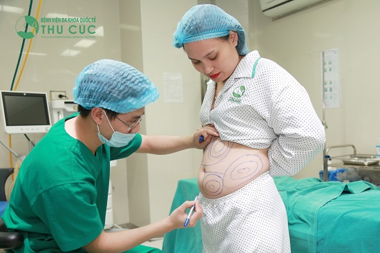 Bác sĩ đo vẽ chính xác vùng mỡ bụng cần giảm để đảm bảo thực hiện hiệu quả và an toàn nhất