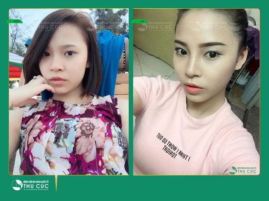 Ưu đãi hấp dẫn: Chỉ từ 7,8 triệu đồng sở hữu ngay dáng mũi đẹp chuẩn Hàn