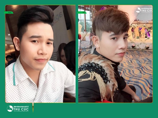 Các phương pháp nâng mũi tại Thu Cúc Sài Gòn thích hợp cho cả nam và nữ (Lưu ý: Kết quả tùy thuộc cơ địa mỗi người)