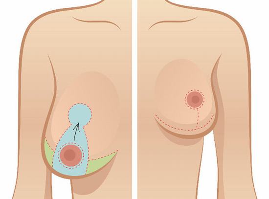 Có rất nhiều nguyên nhân dẫn đến tình trạng ngực chảy xệ