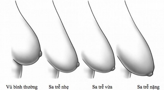Tùy mức độ chảy xệ của khách hàng các bác sĩ sẽ thực hiện kỹ thuật nâng ngực khác nhau