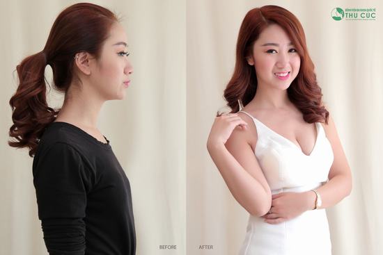 Thu Cúc Sài Gòn là địa chỉ nâng ngực nội soi túi giọt nước uy tín hiện nay (Lưu ý: Kết quả tùy thuộc cơ địa mỗi người)