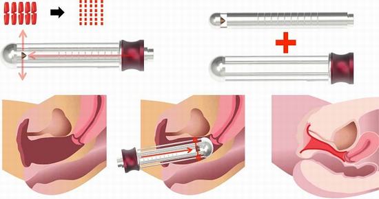 Làm đẹp vùng kín bằng laser là xu hướng mới được ưa chuộng