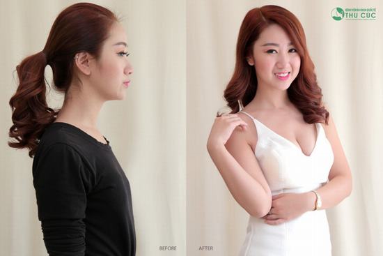 Nhìn hình ảnh này của cô nàng Phương Thảo thì ai mà chẳng muốn nâng ngực. Cô bạn đã thực hiện nâng ngực Nano Chip tại Bệnh viện Thu Cúc.