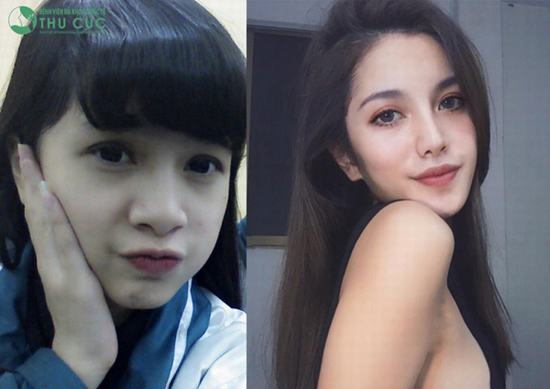 Cô bạn Ngọc Hà đã “dậy thì” thành công sau nâng mũi tại Bệnh viện Thu Cúc