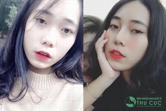 Nâng mũi không phức tạp như bạn nghĩ đâu. Chỉ cần 30 phút đã có dáng mũi cao sang chảnh rồi. Cứ nhìn cô bạn Ngô Linh Chi sau khi nâng mũi S line là sẽ rõ.
