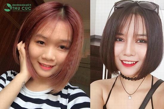 Trên đời này không có con gái xấu, chắc chắn là vậy, chỉ là cô ấy chưa đủ quyết tâm để thẩm mỹ nhan sắc thôi. Nhìn cô bạn Thùy Linh sau khi cắt mí bạn đã có thêm động lực chưa?