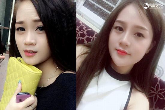 Nếu ngày xưa để nhìn rõ kết quả của những ca nâng mũi bạn phải đợi ít nhất 3 tháng thì bây giờ chỉ cần 2 tuần là form mũi đã ổn định rồi. Hình ảnh cô bạn Nguyễn Thu Hà nâng mũi S line tại Thẩm mỹ Thu Cúc.