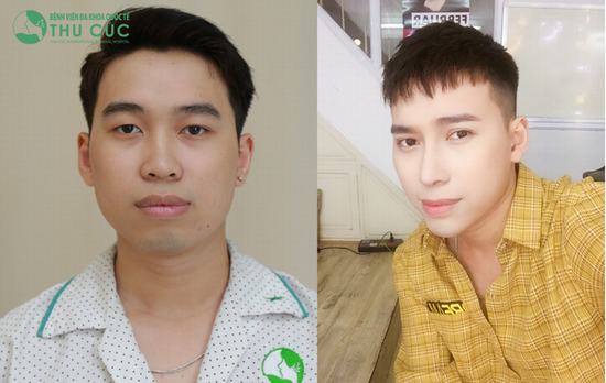 Biết bao ca phẫu thuật thẩm mỹ biến những cô gái, chàng trai thành mỹ nam, mỹ nữ. Ngay cả Top 3 Vietnam Idol Đinh Quang Đạt cũng nhờ đến nâng mũi Liftderm S 5D để hoàn thiện ngoại hình.