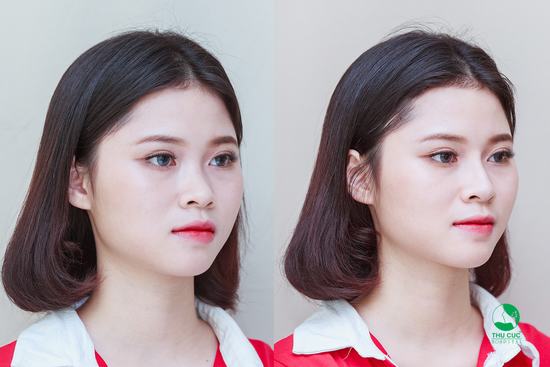 Hình ảnh khách hàng trước và ngay sau khi tiêm mũi tại Thẩm mỹ Thu Cúc Sài Gòn 