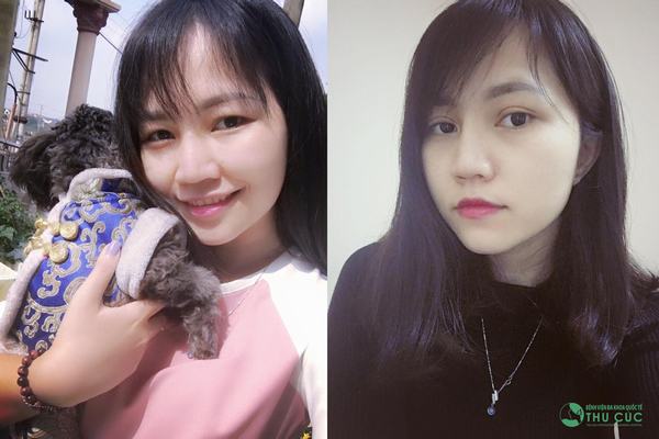 Nhờ đôi mắt 2 mí tự nhiên, Phương Trinh trẻ trung và lôi cuốn hơn hẳn