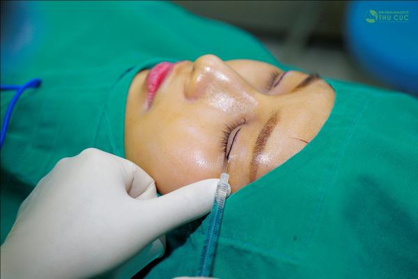 Khách hàng được gây tê để luôn cảm thấy thoải mái, dễ chịu trong suốt quá trình phẫu thuật