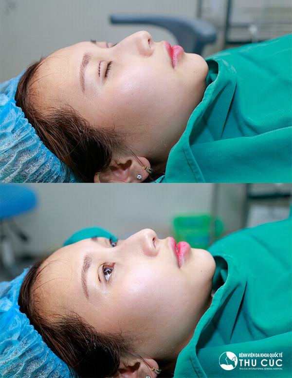 Chỉ sau khoảng 45 phút, nếp mí mới sẽ được hình thành rõ nét, không còn tình trạng da dư, mỡ thừa