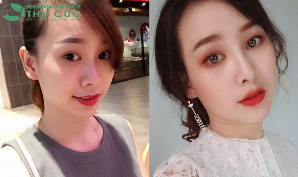 Trương Mỹ Linh khoe góc nghiêng thần thánh sau khi nâng mũi