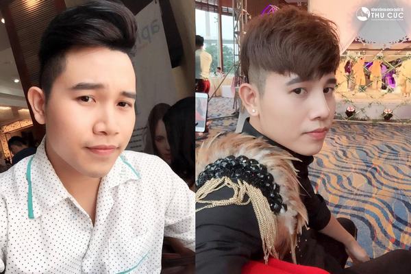Nâng mũi High - Line phù hợp với cả nam giới