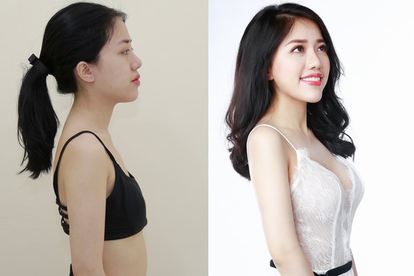 Thực hiện nâng ngực túi Nano Chip Ergonomic, nữ ca sĩ The Voice Phùng Khánh Linh đã "lột xác" xinh đẹp và quyến rũ hơn rất nhiều