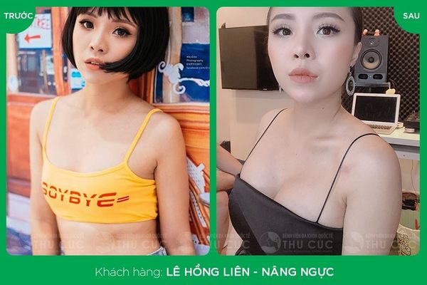 Khuôn ngực khách hàng sau khi nâng ngực Nano Chip cực kỳ tự nhiên (Lưu ý: Kết quả tùy thuộc cơ địa mỗi người)