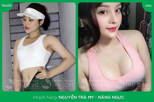Túi ngực Nano Chip có thể di chuyển linh hoạt và đảm bảo giữ nguyên vẹn cảm giác (Lưu ý: kết quả tùy thuộc cơ địa mỗi người)