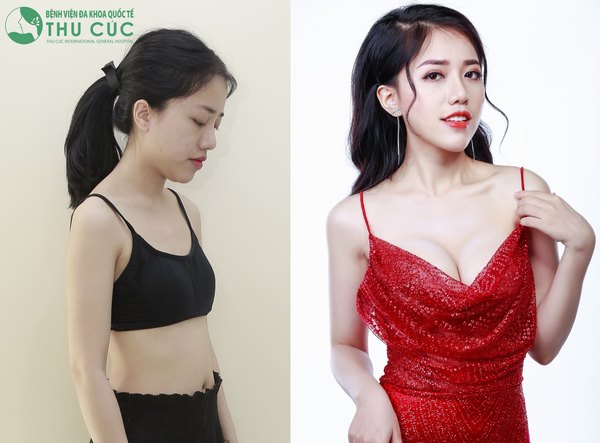 Mọi khách hàng khi có nhu cầu đều có thể tham gia chương trình nâng ngực 0 đồng