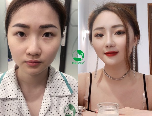 Sự lột xác hoàn hảo của khách hàng chỉ nhờ dịch vụ nâng mũi đơn giản tại Thu Cúc