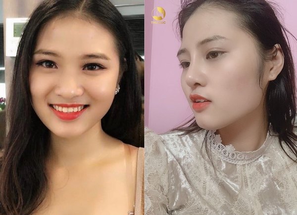 Nâng mũi cũng là 1 trong những dịch vụ được miễn phí hoàn toàn trong chương trình ưu đãi lần này
