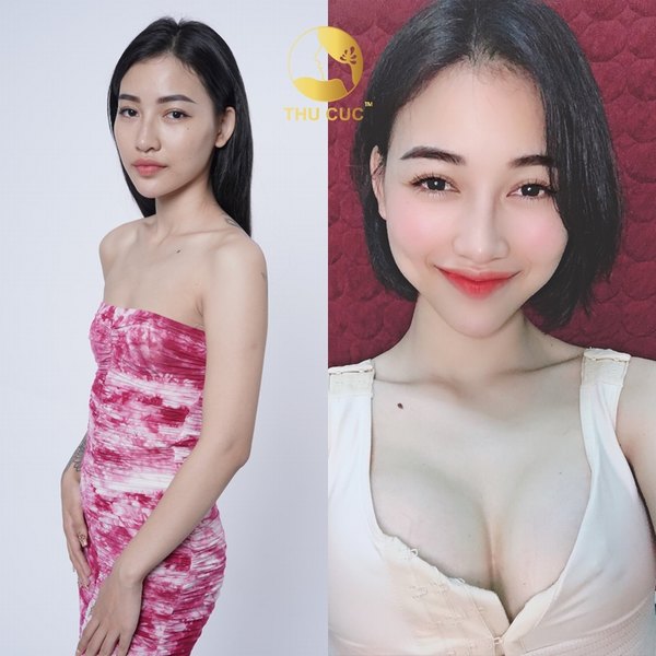 Sở hữu vòng 1 đẹp hoàn hảo, không cần lo chi phí là điều dễ dàng